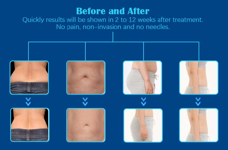 Cryolipolysis - Fat Freezing Machine