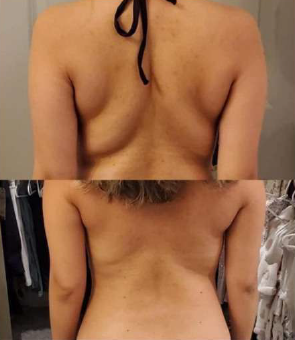 Cryolipolysis - Fat Freezing Machine
