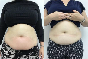Cryolipolysis - Fat Freezing Machine